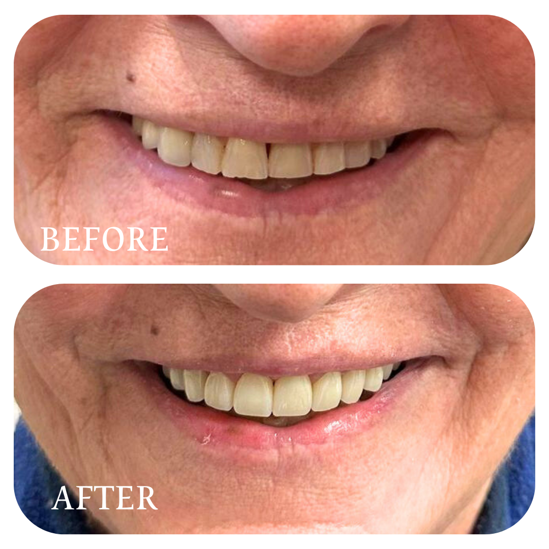 Smile Gallery | Real Patient Before & After Smiles at Smile 24